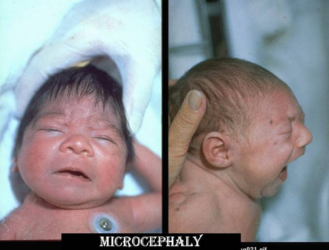 microcephaly newborn