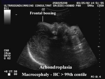 macrocephaly ultrasound