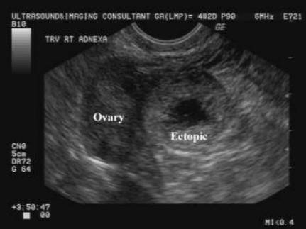 ovarian ectopic pregnancy ultrasound