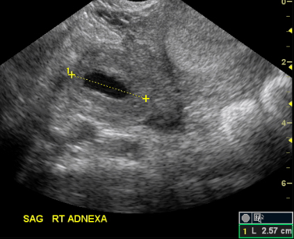 ectopic pregnancy ultrasound ring of fire