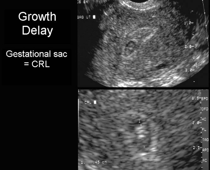 Yolk Sac Size Chart - Estimating Fetal Gestational Age Radiology Key.