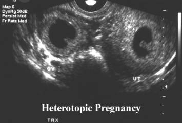 Pregnancy, Heterotopic