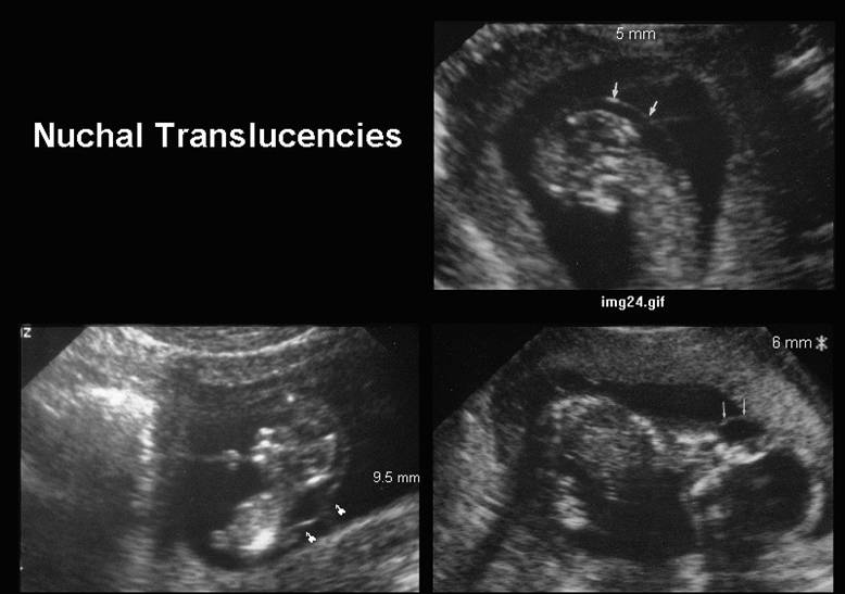 sequential screening with nuchal fold translucency