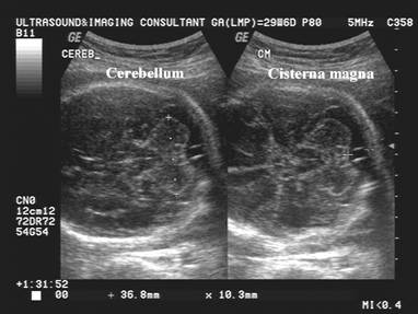 normal fetal cisterna magna mri