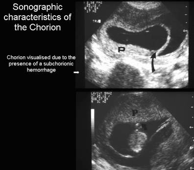 chorionic villi ultrasound