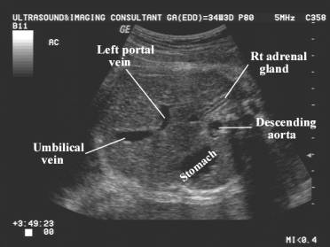 umbilical vein ultrasound