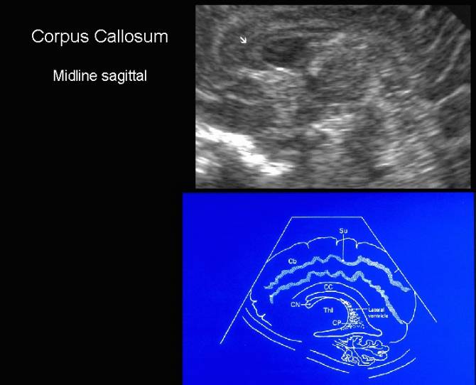 Ultrasound Of The Corpus Callosum 