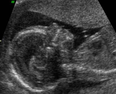 Trisomy on Trisomy 18     Absent Nasal Bone