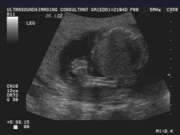 club foot ultrasound