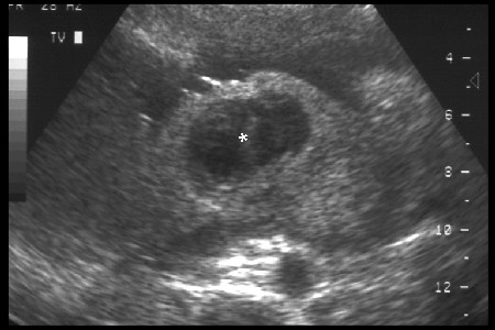 Chorioangioma Of Placenta