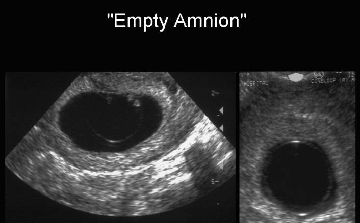 Gestational Sac in Pregnancy and Meaning If Empty