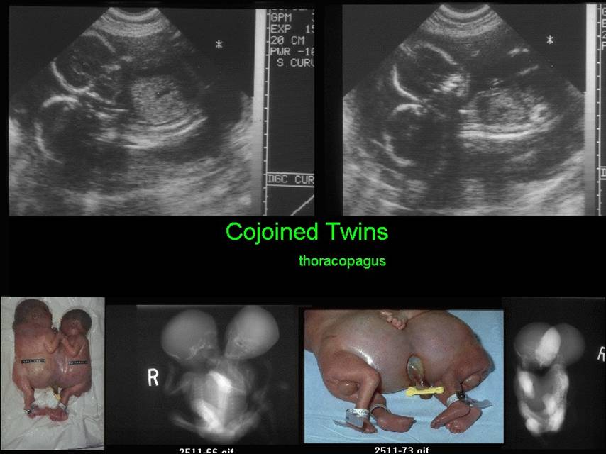 Types Of Conjoined Twins