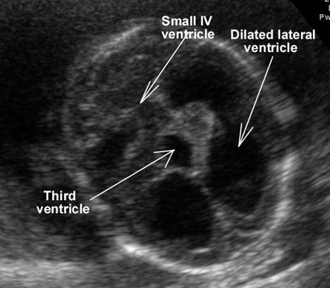 Dilated Third Ventricle
