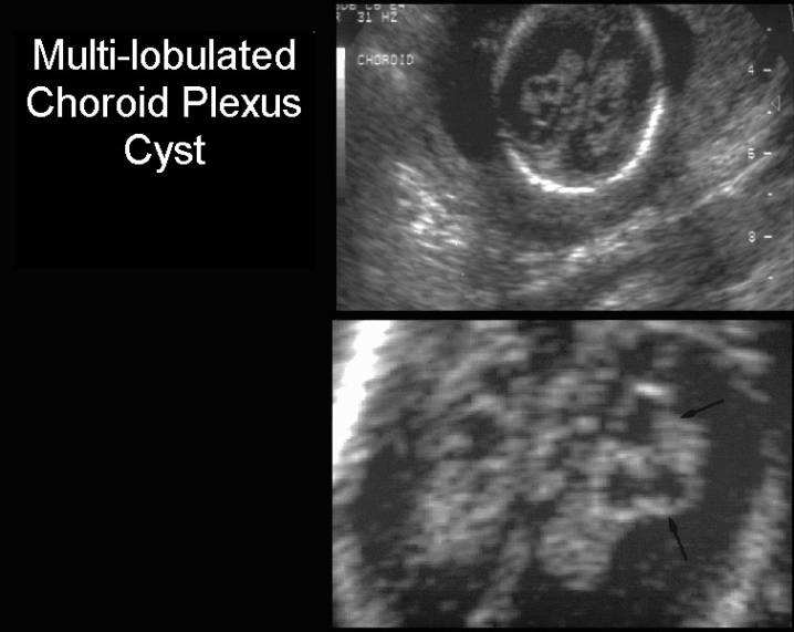 Internal Structure Of Choroid Plexus Cysts 