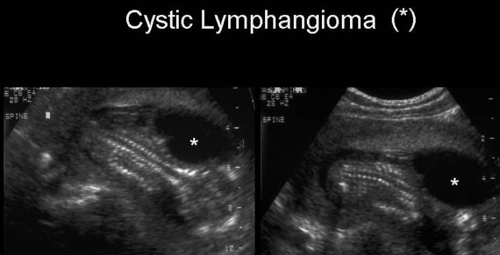 cystic hemangioma