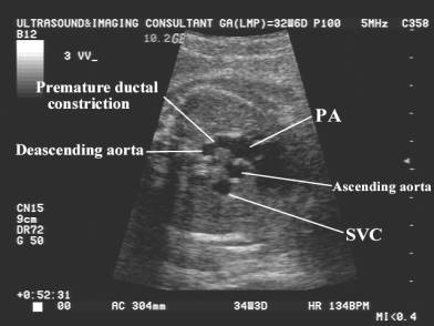 Premature Constriction Of The Ductus Arteriosus