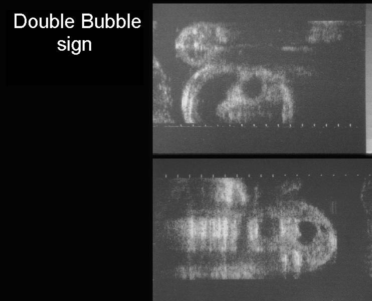 double bubble duodenal atresia
