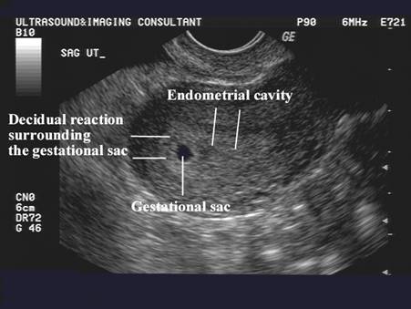 lesser sac ultrasound