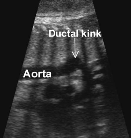 Ductus Arteriosis