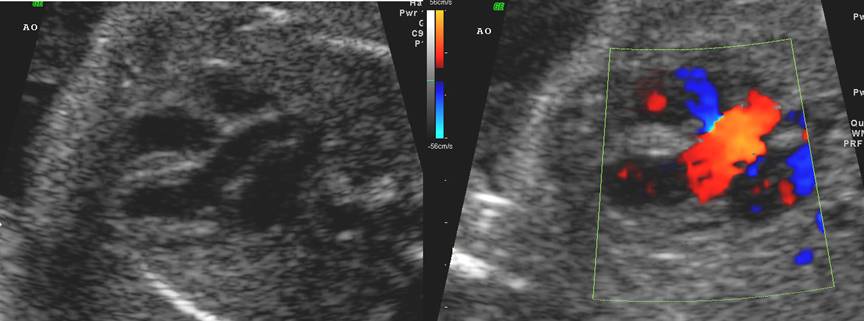 Ascending Aorta, Arch And Descending Aorta