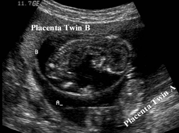 Bronchial Atresia