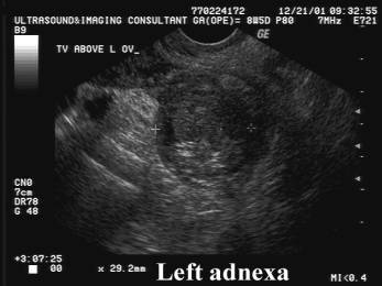 Transverse cerebellar diameter