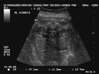 Bronchial Atresia