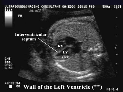 Endocardium