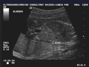 Esophageal Atresia And Chromosomal Aneuploidy