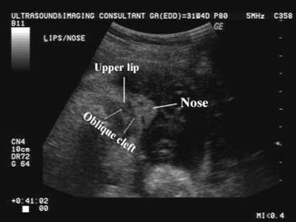 cleft lip ultrasound