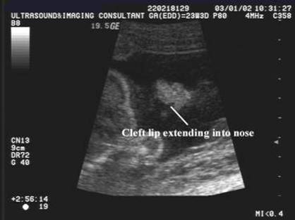 cleft palate ultrasound
