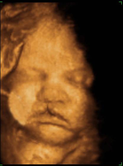 Ultrasound Of Cleft Lip And Palate