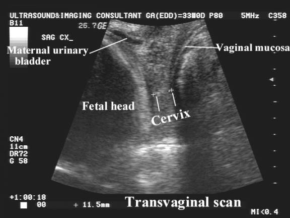 Cervical Length In Pregnancy