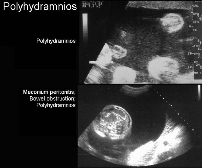 polyhydramnios ultrasound