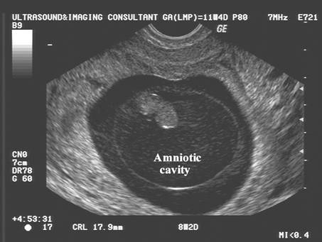 First Trimester Pregnancy Failure Enlarged Amniotic Cavity