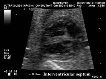 Fetal Cardiomyopathy