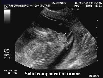 Ultrasound In Sacrococcygeal Teratoma